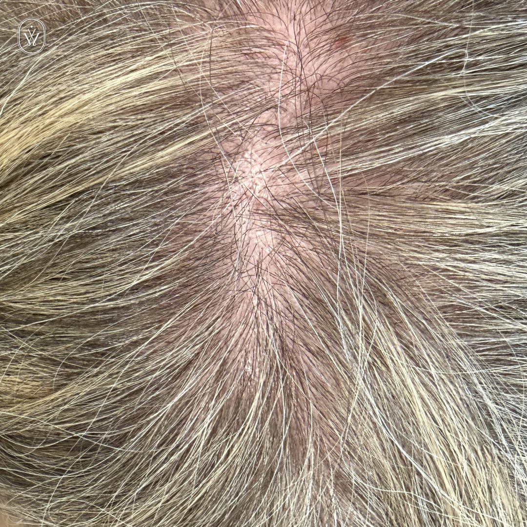 Close up of a part in light brown hair showing exposed scalp with fine hair strands