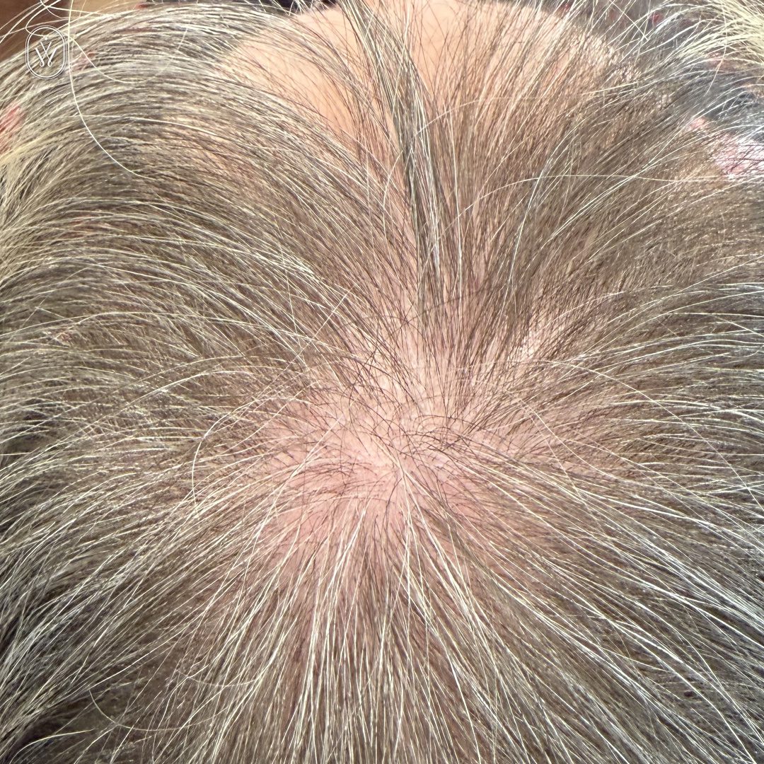 Close up of a balding crown with sparse gray hair and exposed pink scalp at the top of the head showing thinning areas