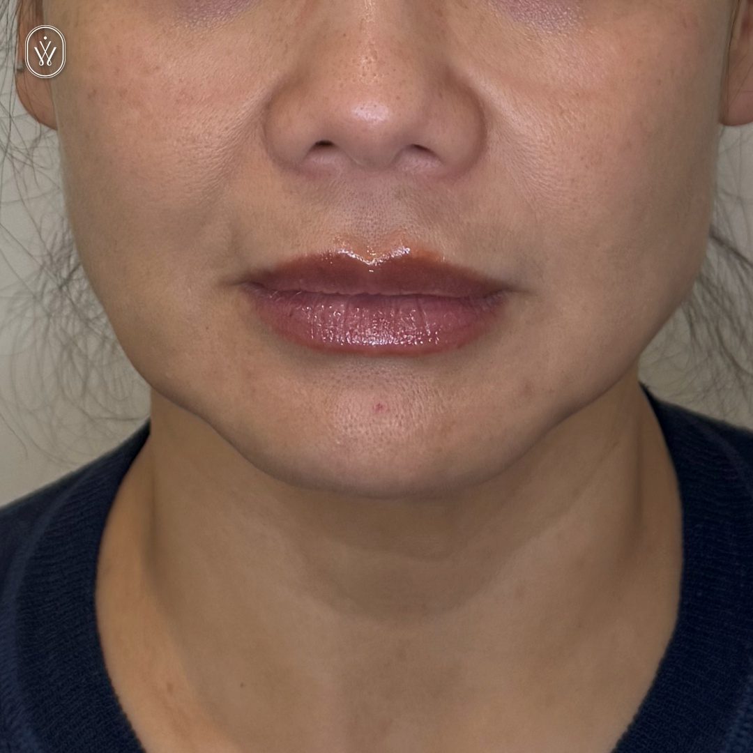 Client 12 after lower face botox infinite wellness med spa pasadena Close up of a womans lips wearing shiny pink lip gloss with skin texture visible around the mouth