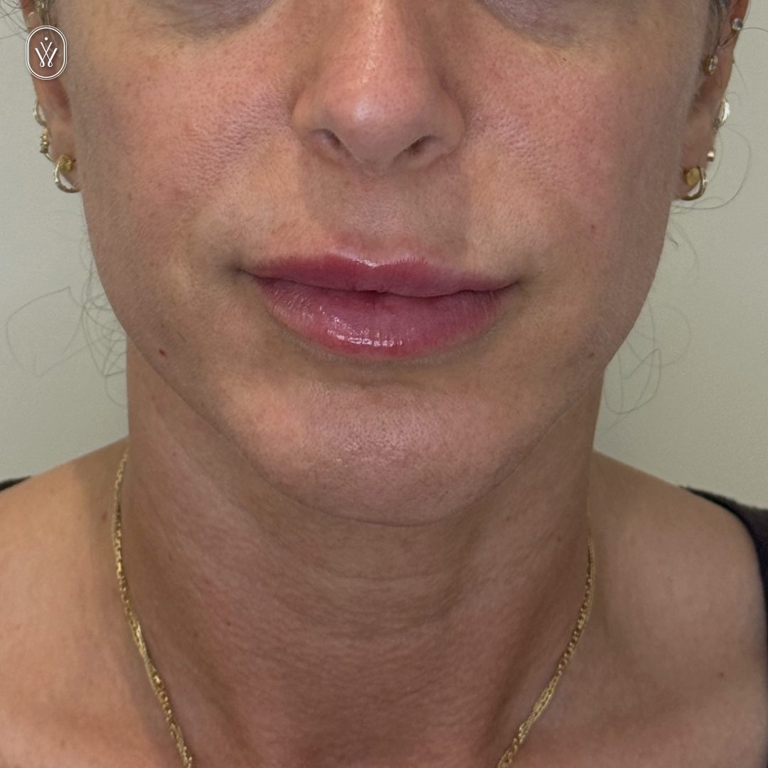 Client 14 after lower face laser infinite wellness med spa pasadena Close up of a womans lower face and neck with glossy pink lips gold earrings and a gold chain visible