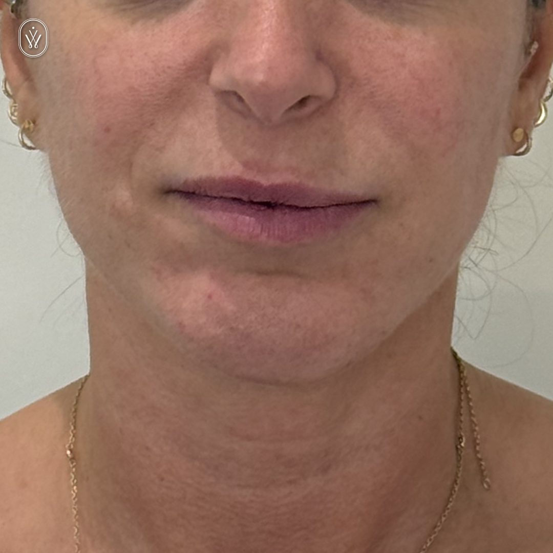 Client 14 befroe lower face laser infinite wellness med spa pasadena Close up of a womans lower face and neck showing red uneven skin and small blemishes on the cheeks and chin with a gold chain necklace visible