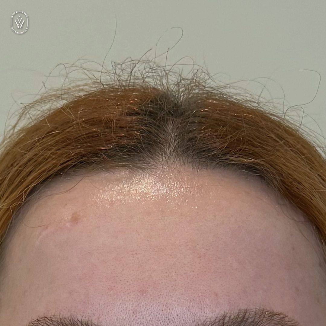 Client 7 after forehead botox infinite wellness med spa pasadena Close up of a forehead with shiny oily skin and visible pores with a brown hairline at the top and a small blemish on the left side
