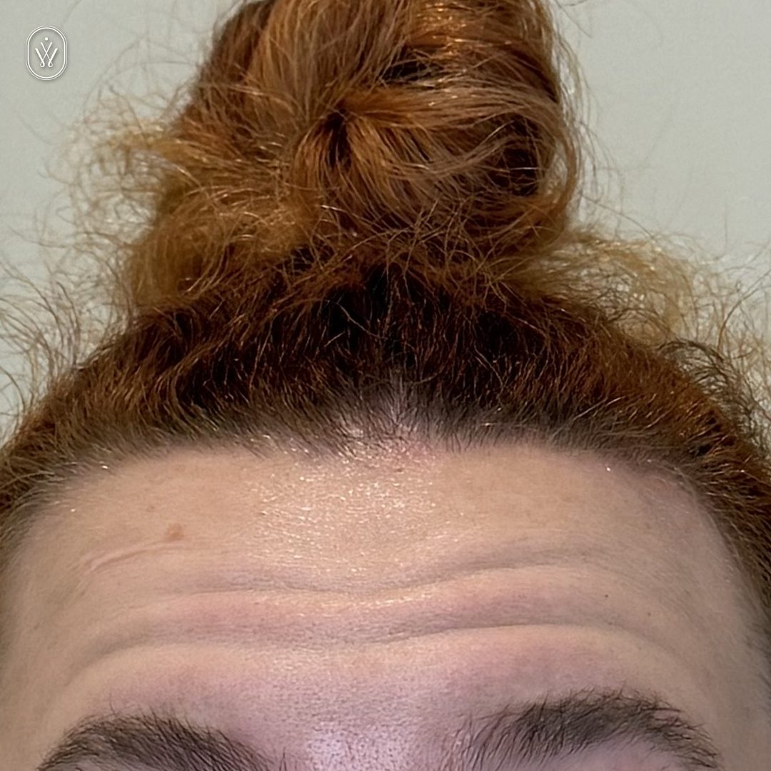 Client 7 before forehead botox infinite wellness med spa pasadena Close up of a persons forehead with a red messy bun on top and light purple eye makeup visible