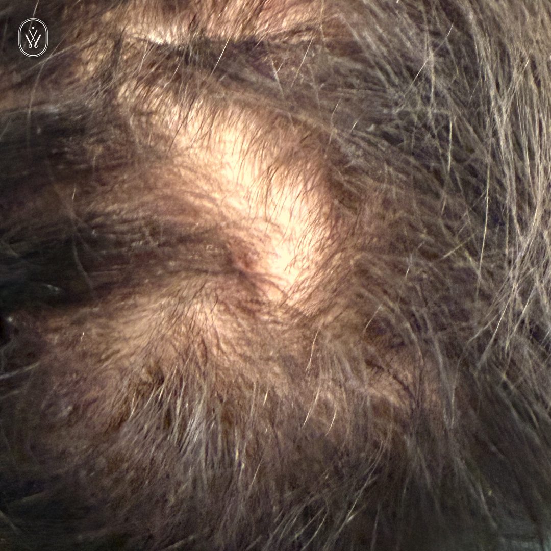 Close up of a balding scalp with thinning hair around a bare patch and surrounding strands of hair