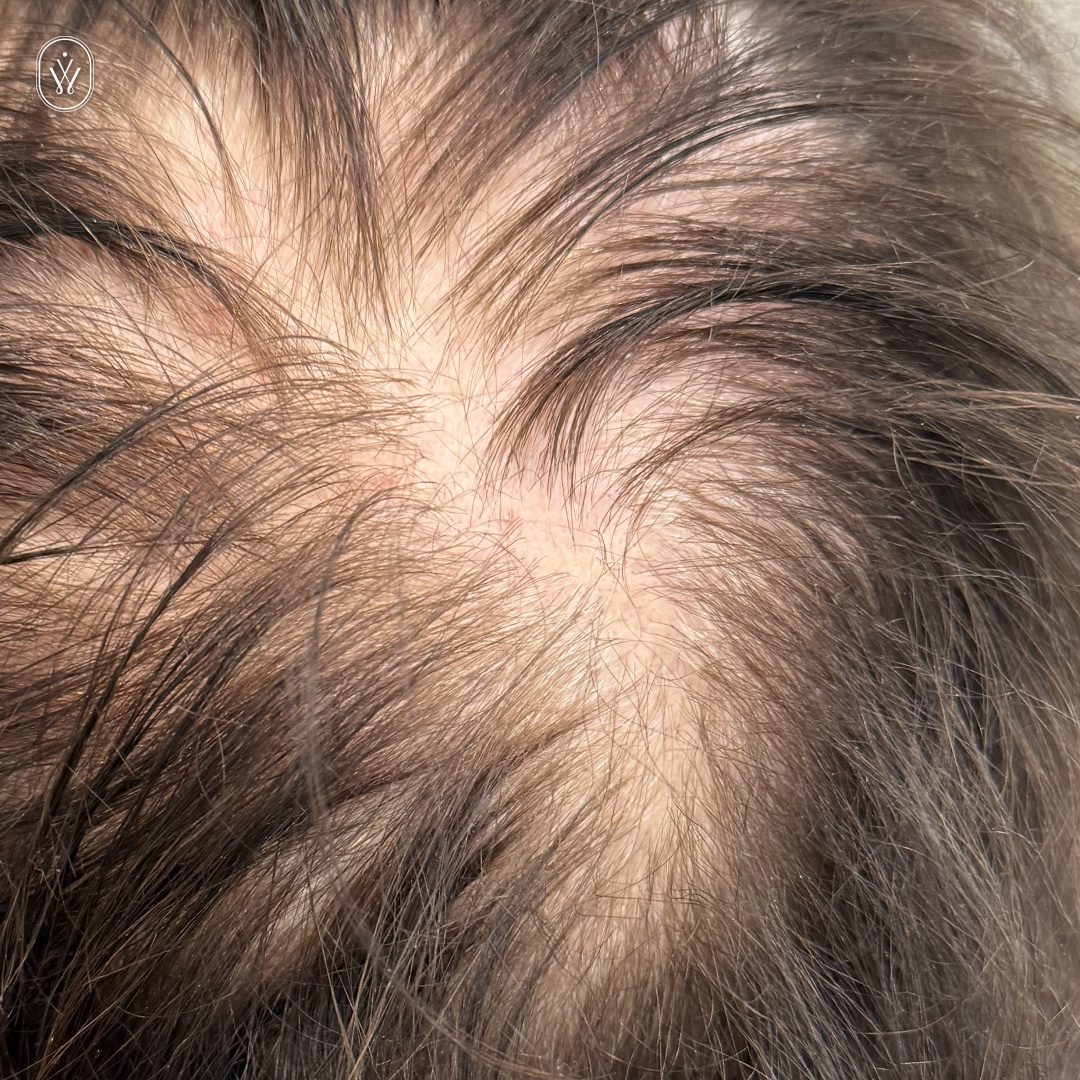 Close up of a scalp with noticeable hair thinning and a small bald patch at the crown