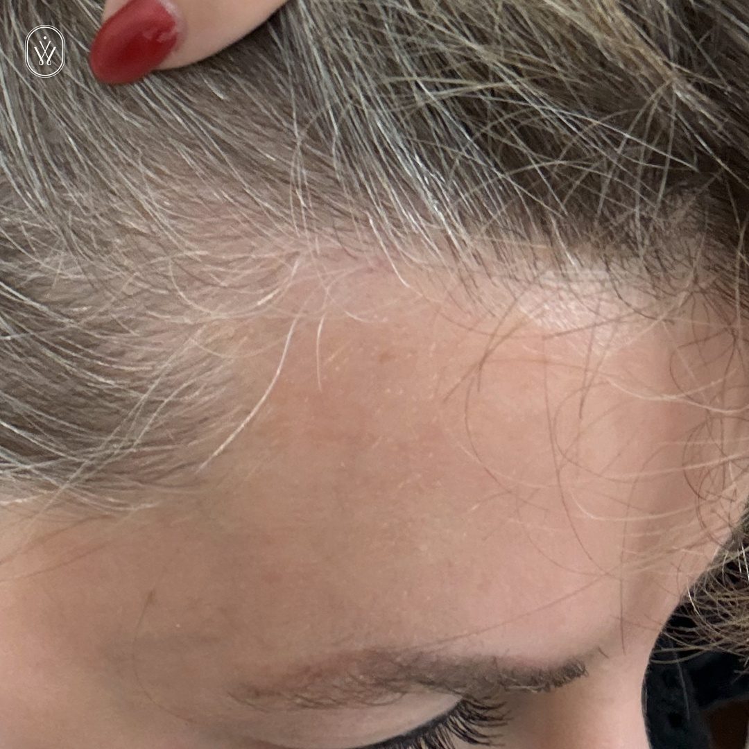 Close up of a hairline and forehead with a finger lifting the hair exposing the skin and eyebrow area
