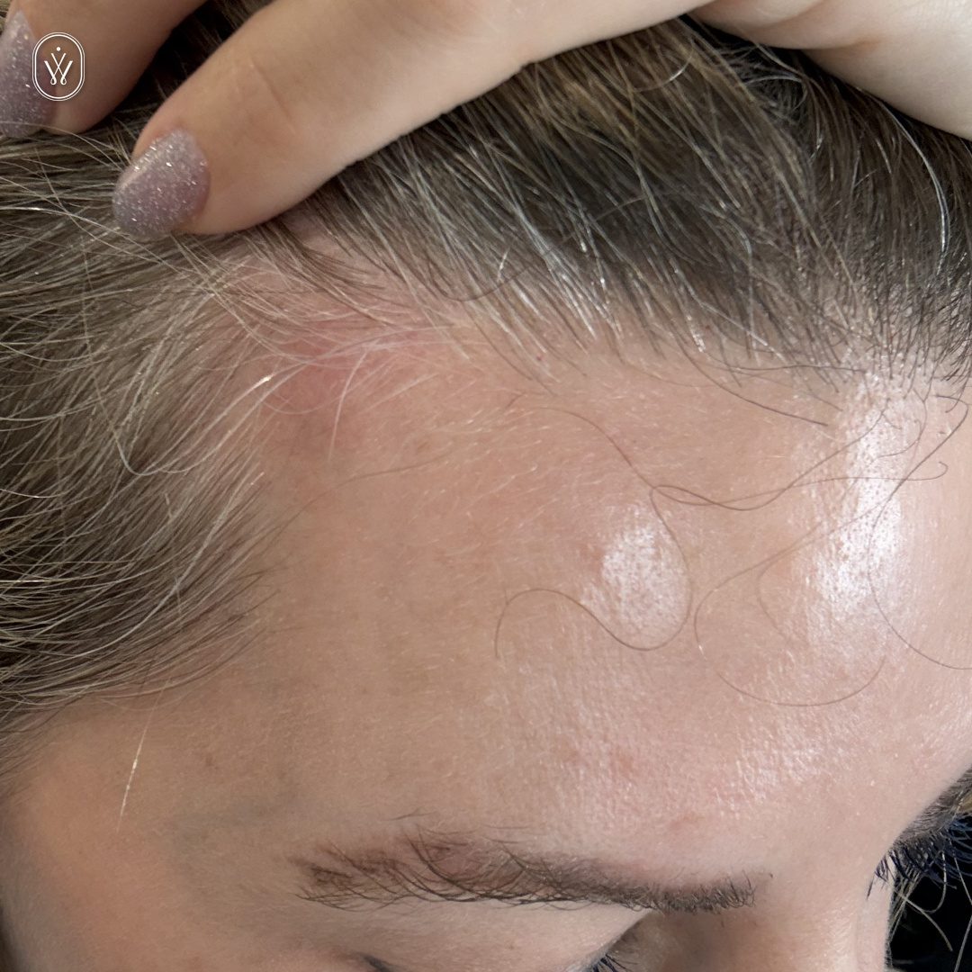 Close up of a persons hairline and forehead as they pull back hair with a hand showing smooth skin and a few stray hairs