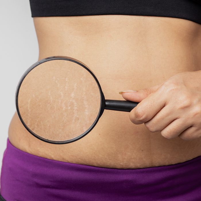 Midsection of a person’s abdomen with light stretch marks viewed through a handheld magnifying glass.