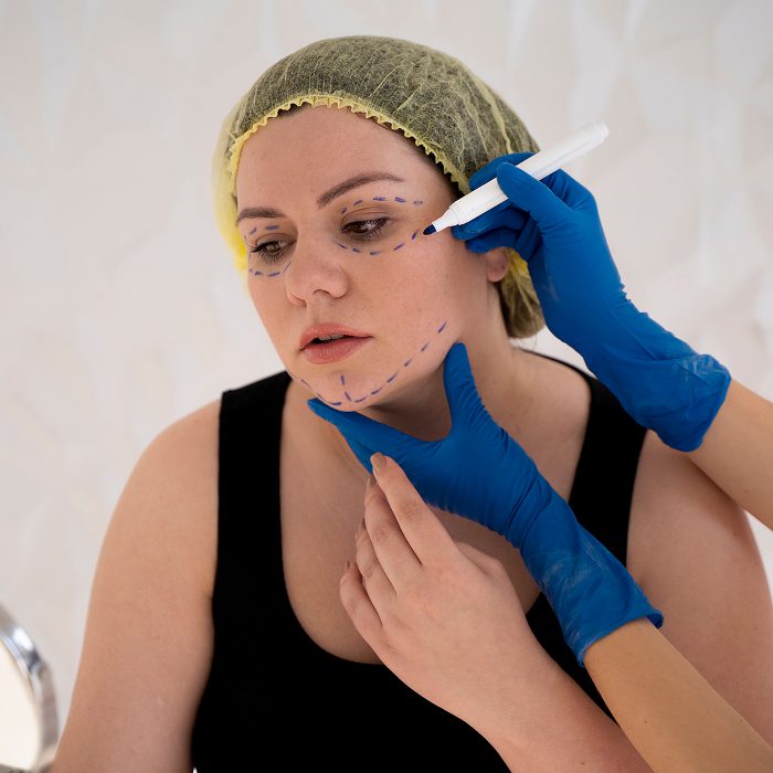 Woman with facial surgical markings being drawn along jaw and cheek by a clinician in blue gloves